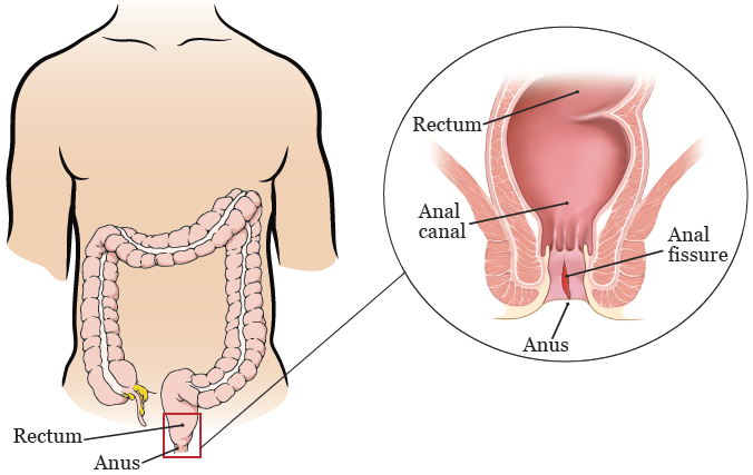 Lifestyle Habits to Avoid Anal Fissures