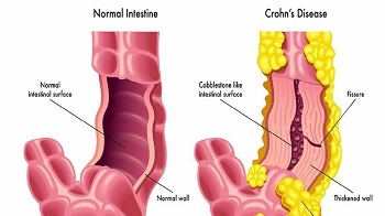 Crohn's Disease Treatment