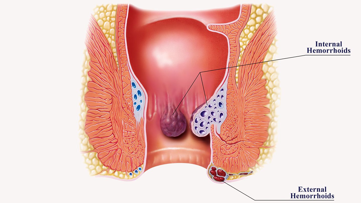 Hemorrhoids