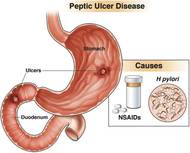 PUD (Peptic Ulcer Disease)
